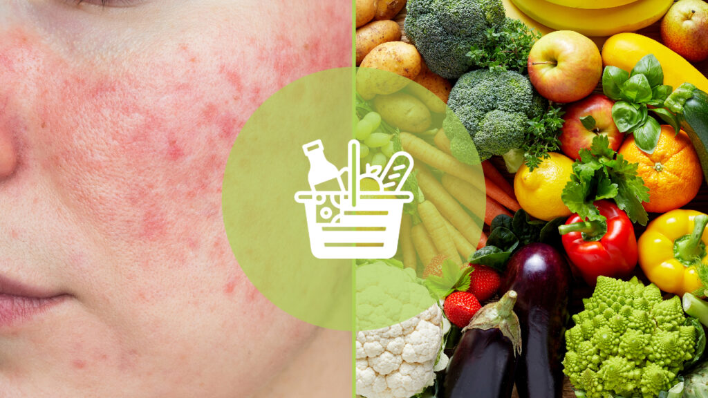 Rosacea Ernährung – welche Lebensmittel lindern Rosacea Hautprobleme.